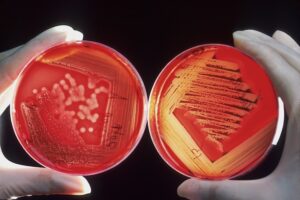 The Increasing Threat of Multidrug-Resistant Infections Causes, Risks, and Preventive Measures